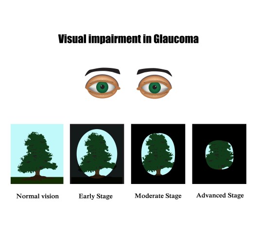 Getting the Facts about Glaucoma