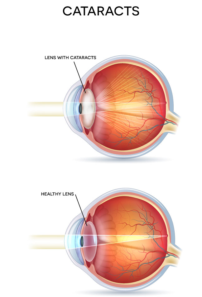 Cataracts Diagram 1024x329
