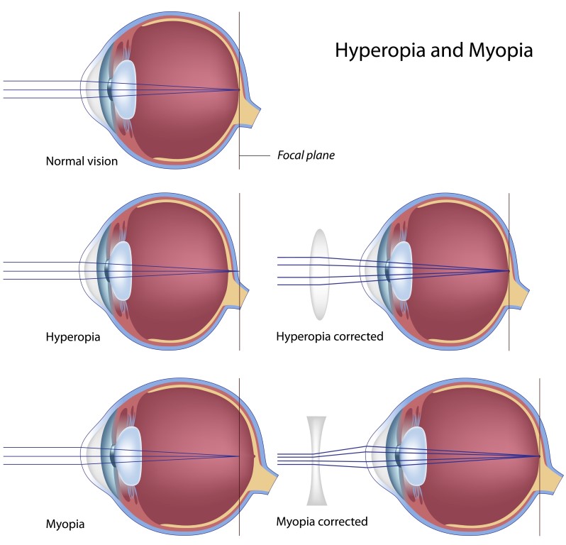 Corrective Lenses Glasses Corrective Lenses Glasses